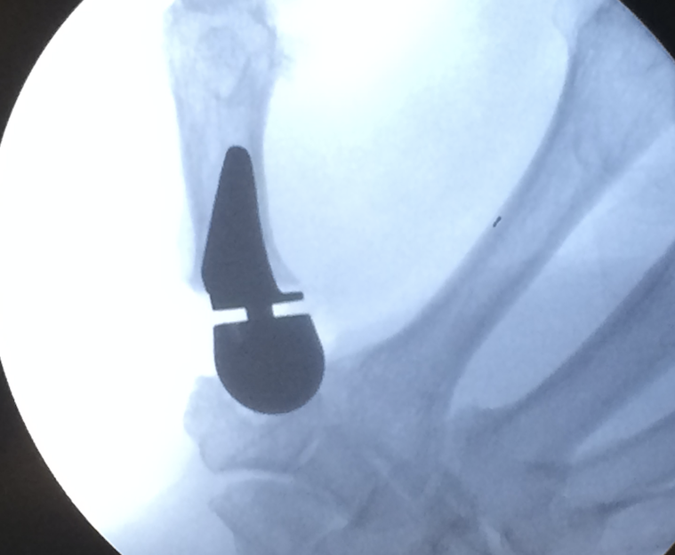 BioPro Modular Thumb Implant (Implant 2011021)